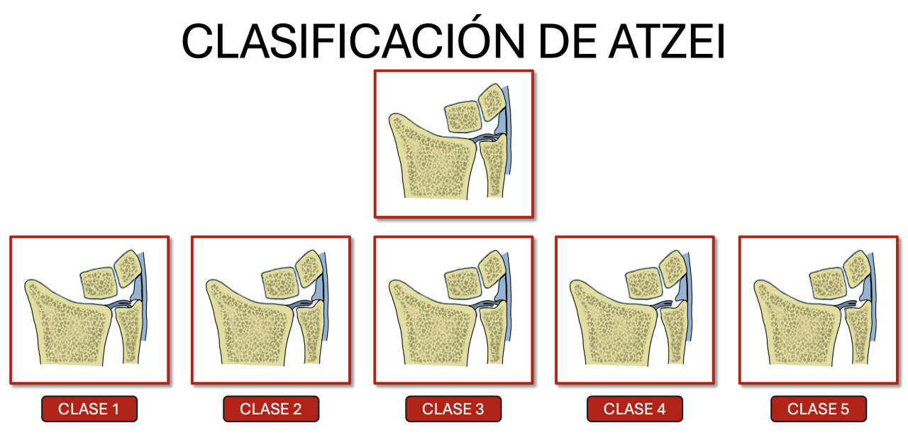 EL FIBROCARTÍLAGO TRIANGULAR - Dr. Roberto Cibantos Martínez