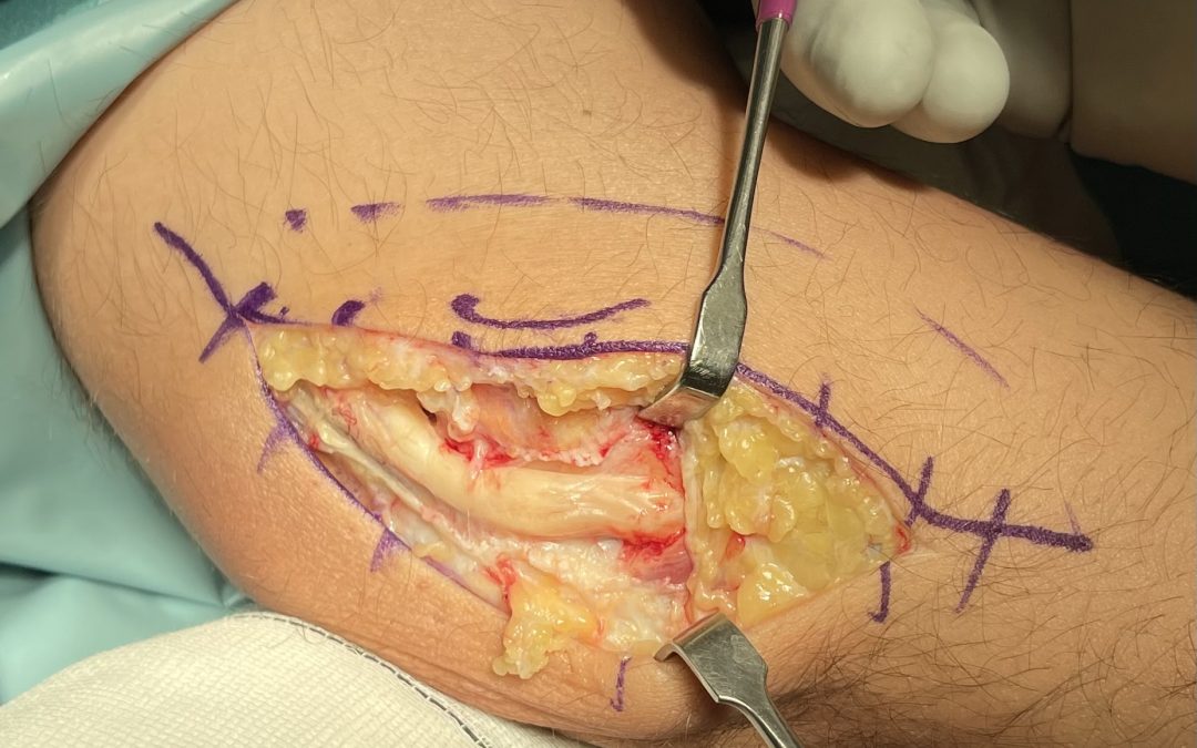 NEUROPATÍA CUBITAL
