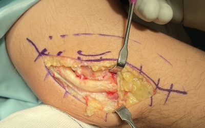 NEUROPATÍA CUBITAL