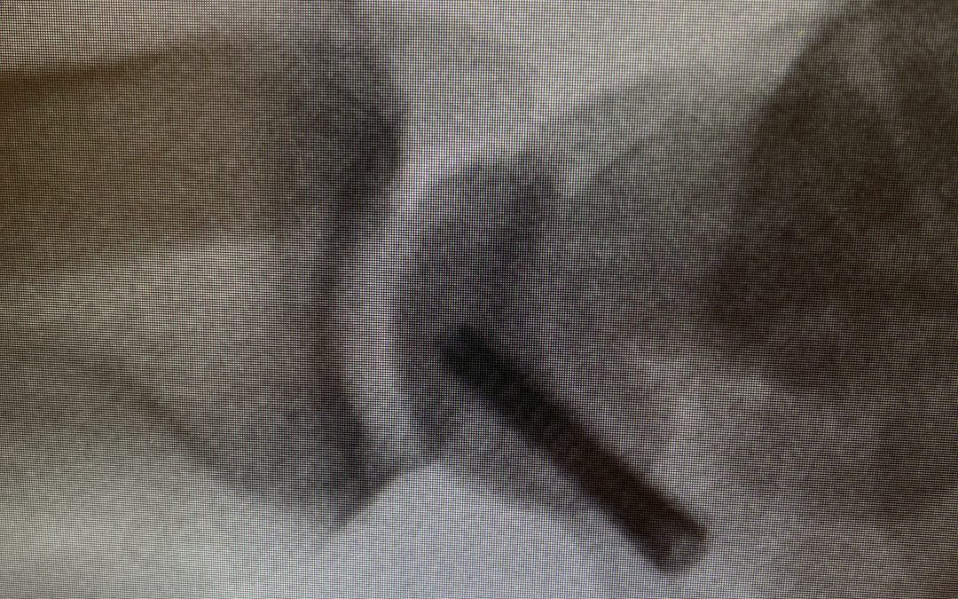 FRACTURAS DE ESCAFOIDES