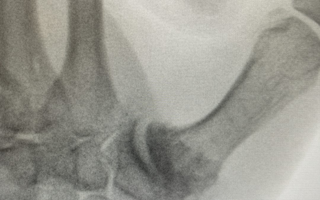 RIZARTROSIS