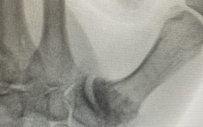 RIZARTROSIS