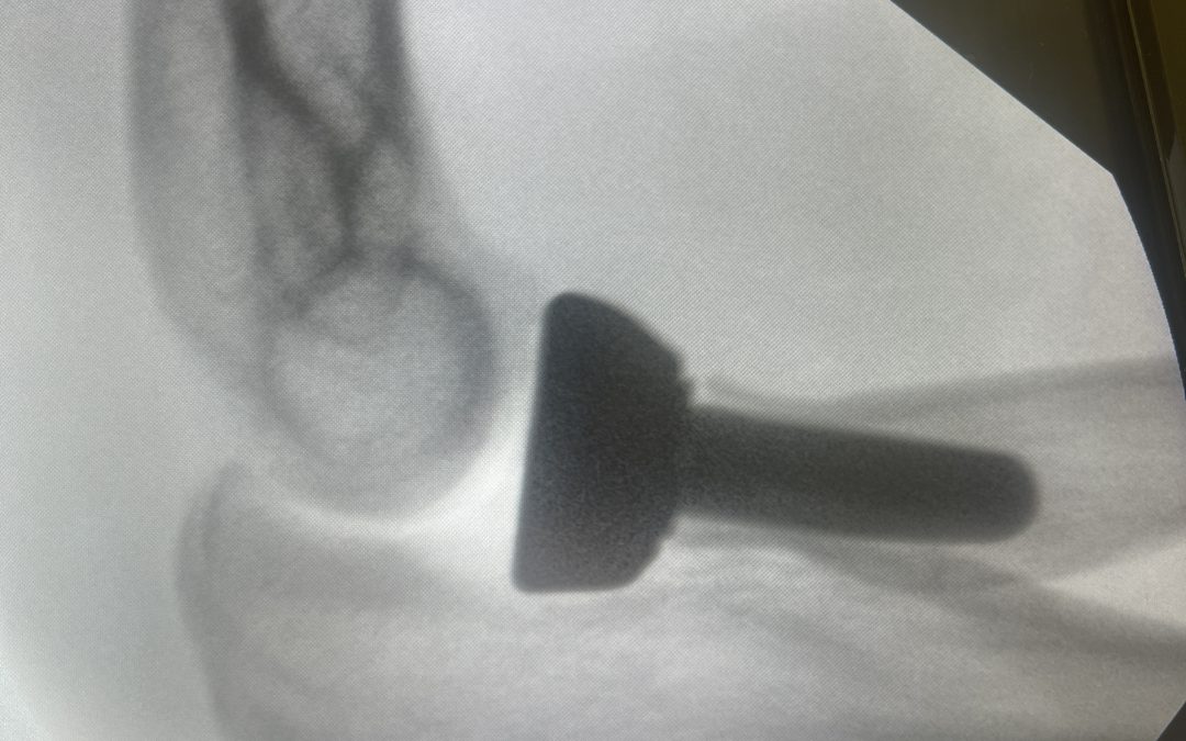 FRACTURAS DE LA CÚPULA RADIAL